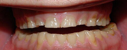 Imploodonto - Bruxismo é uma desordem funcional que se caracteriza pelo  ranger ou apertar dos dentes durante o sono. Essa pressão pode provocar  desgaste e amolecimento dos dentes. Nos casos mais graves
