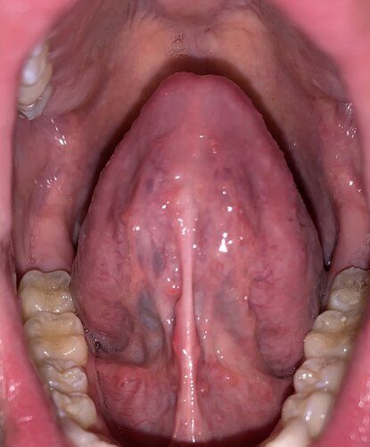 Inchaços embaixo da língua, o que podem ser? - Dentalis