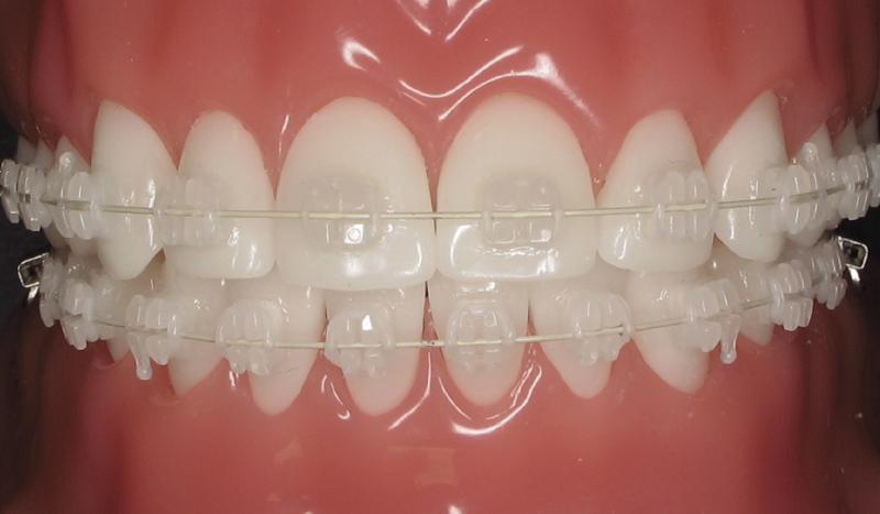 Aparelhos de cerâmica: Prós e Contras - Dentalis