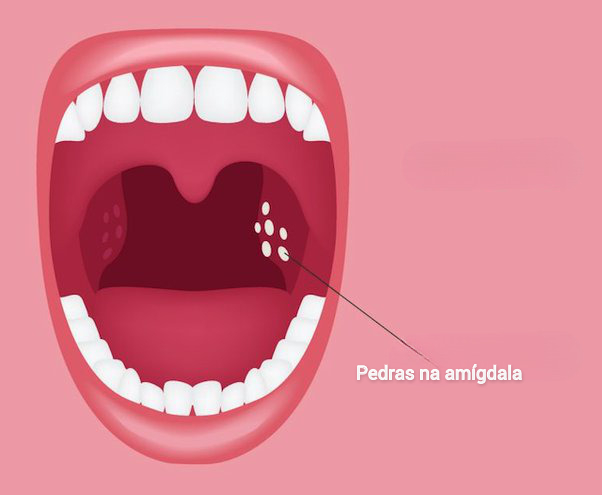 Bolinhas brancas na garganta: por que causam mau hálito?